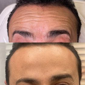 بوتاکس صورت – رفع چین و چروک