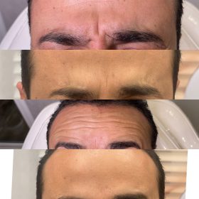 بوتاکس صورت