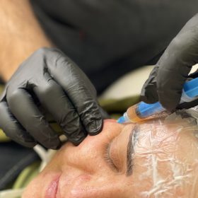 سابسیژن به همراه تزریق پی آر پی