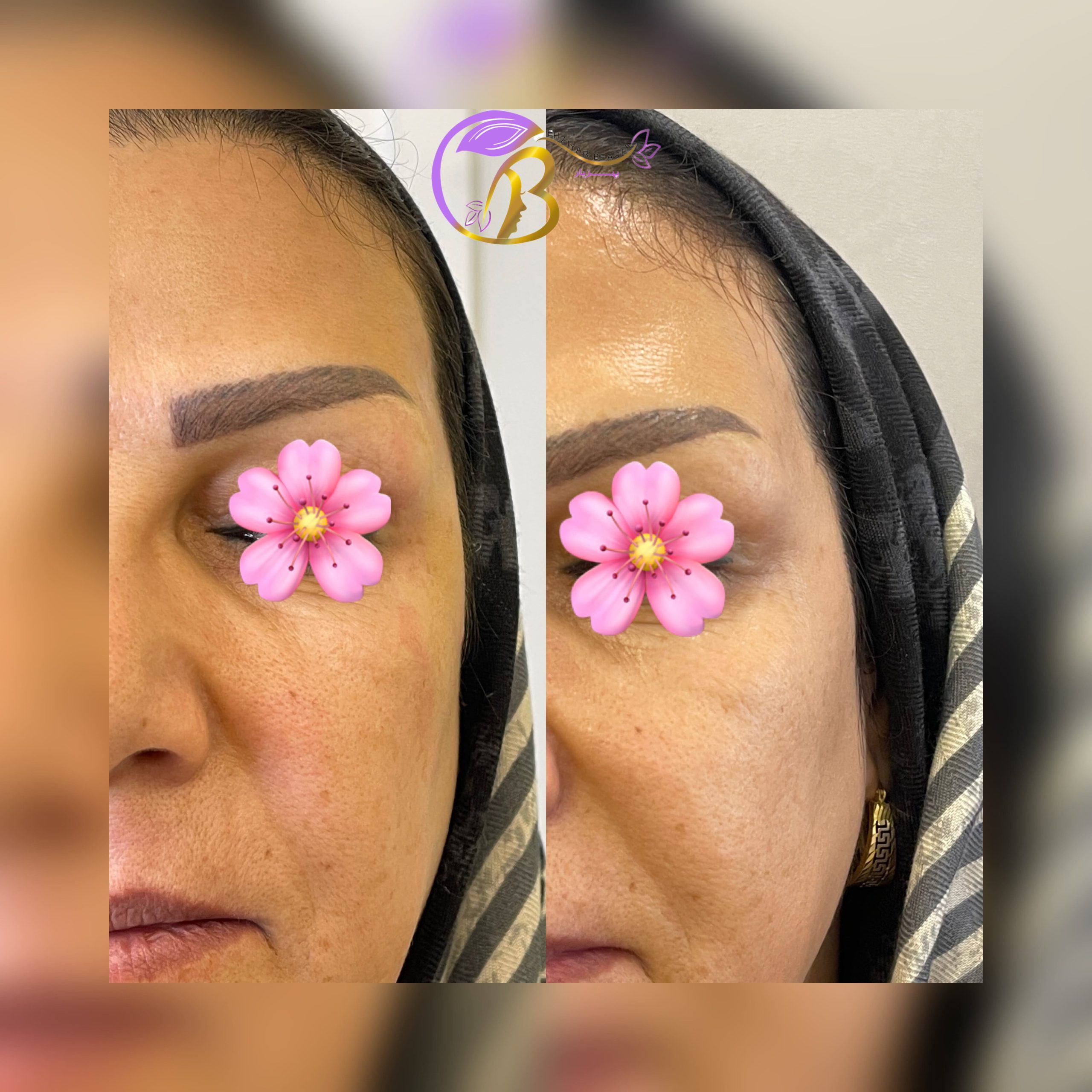 فیلر شقیقه برند نورامیس برای خانم سمت چپ