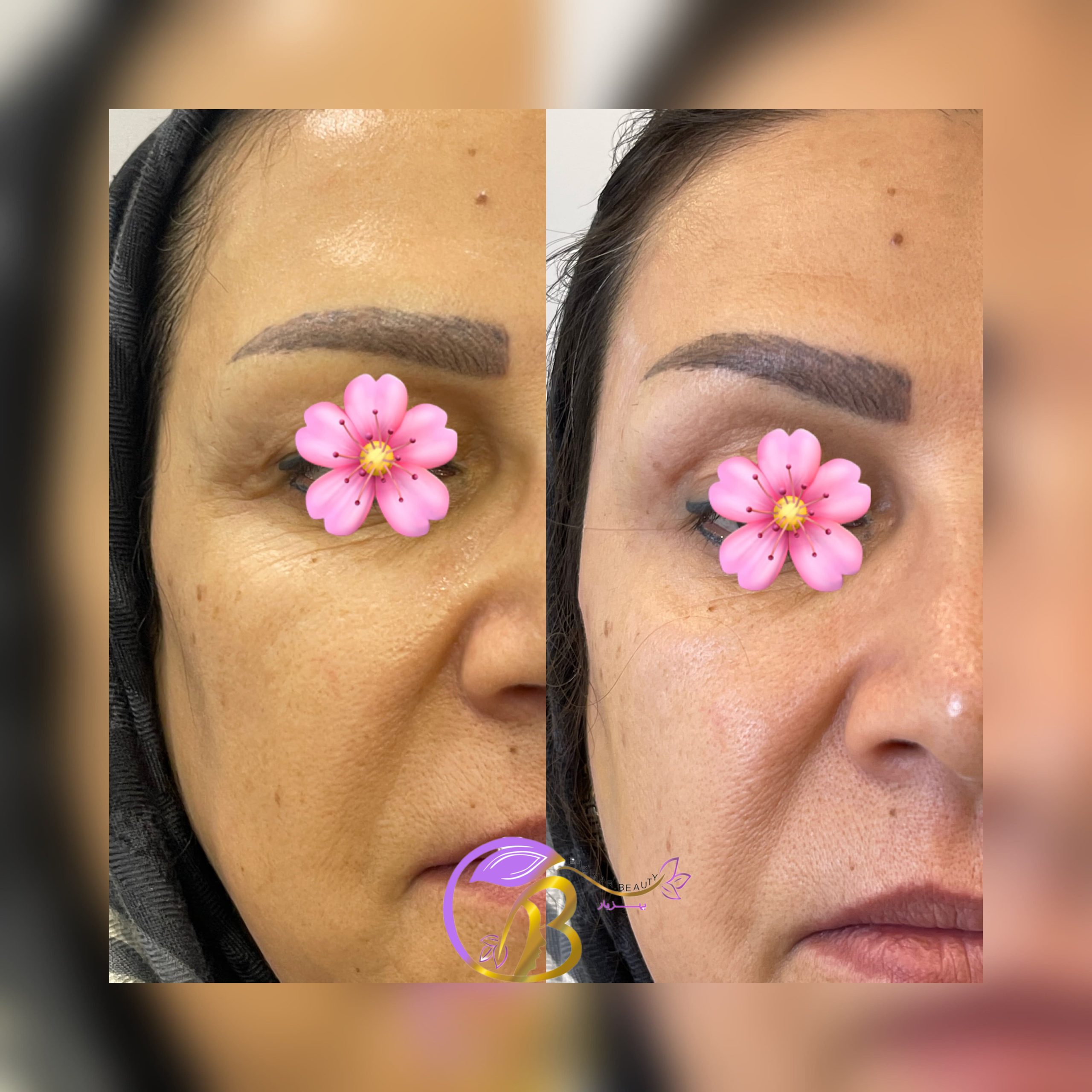 فیلر شقیقه برند نورامیس برای خانم سمت راست