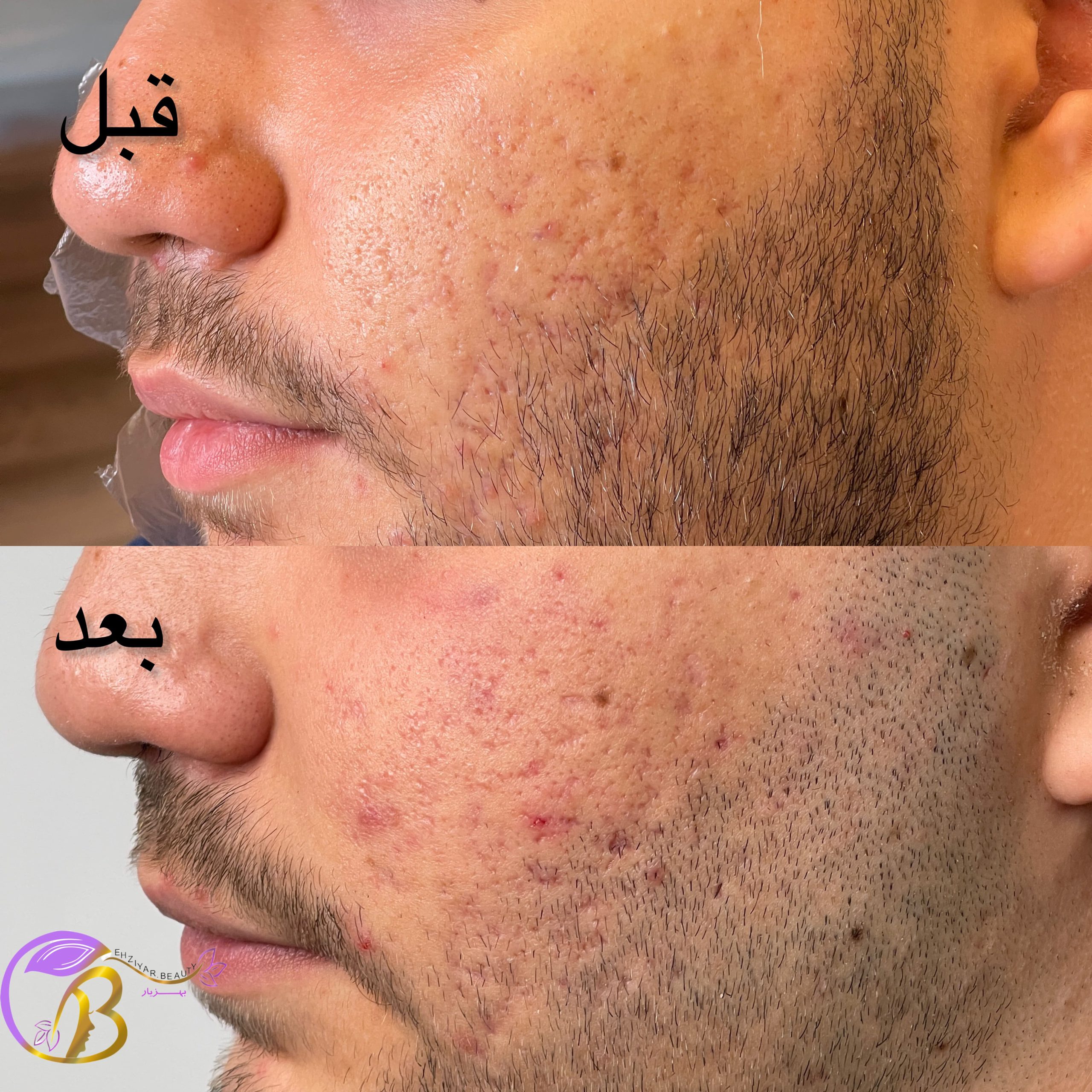 قبل و بعد سابسیژن برای جای جوش های قدیمی و اسکار برای آقا