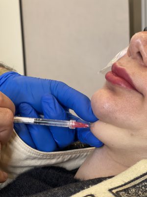 نمونه کار مزو چربی غبغب برای یک خانم