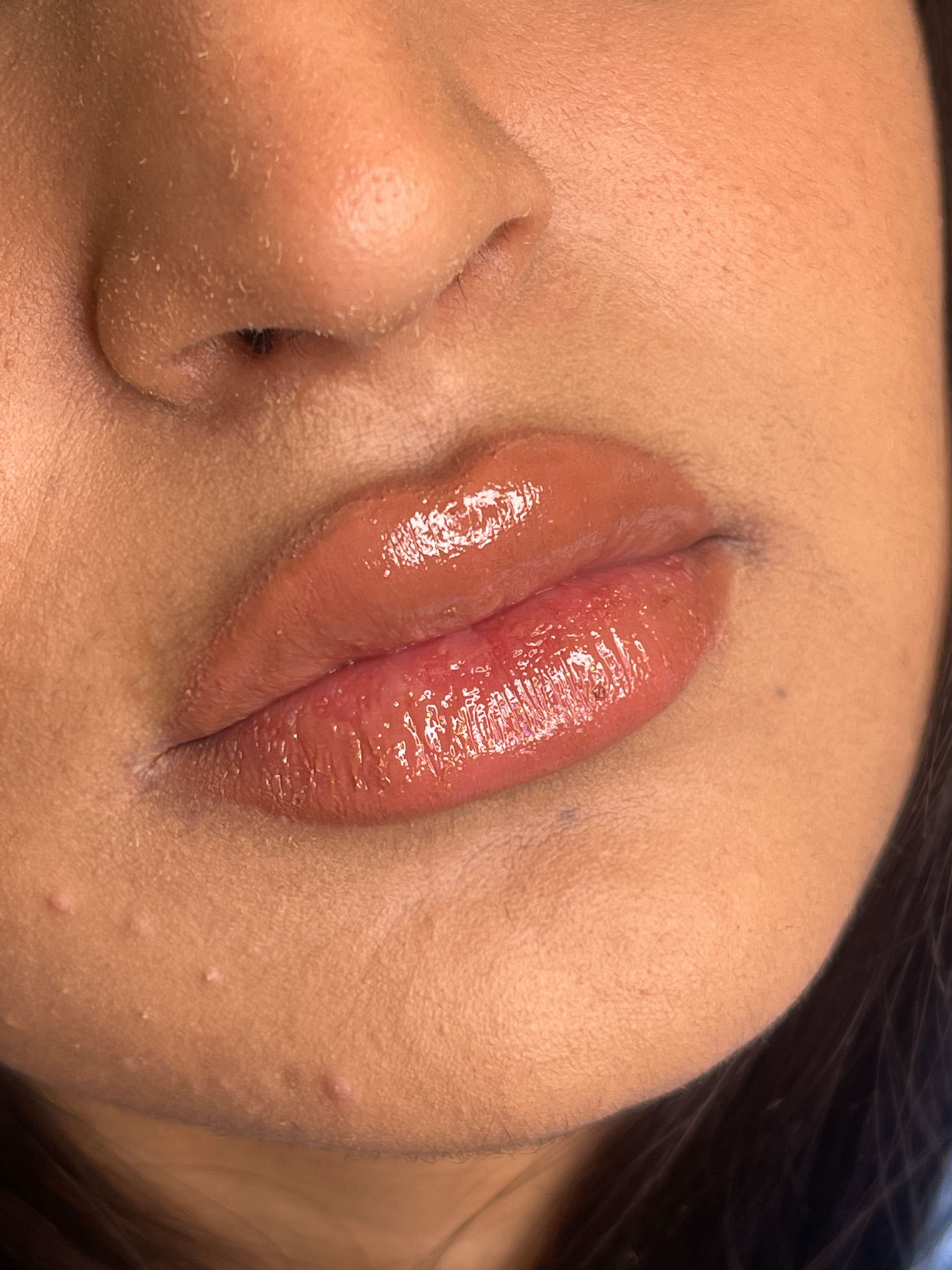 تزریق ژل لب یک سیسی برای خانم