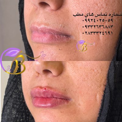 تزریق فیلر لب