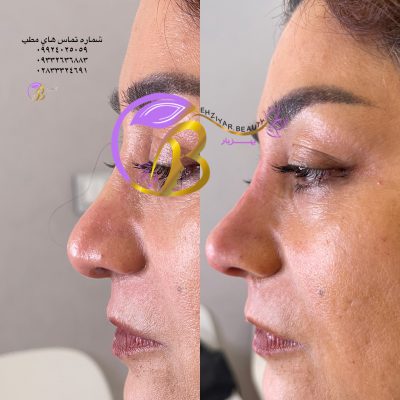 لیفت بینی با نخ