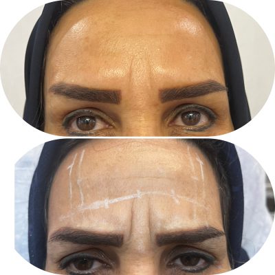 تزریق بوتاکس پیشانی رفع چروک