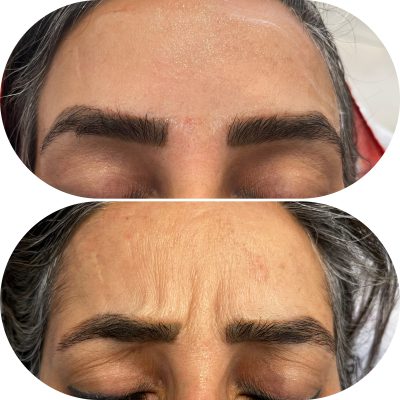 بوتاکس پیشانی خانم میان سال