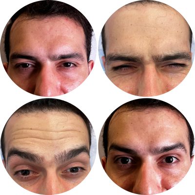 تزریق بوتاکس پیشانی آقا برای برطرف شدن چروک