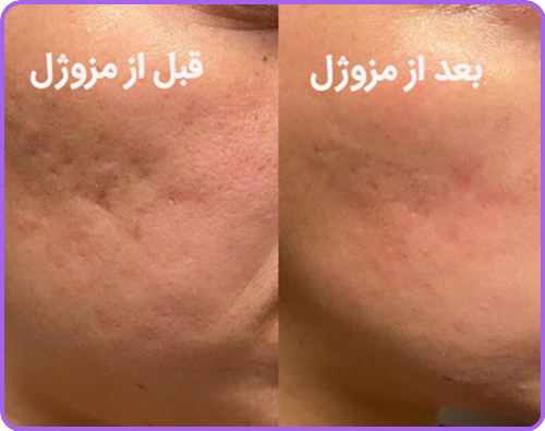 عکس قبل و بعد مزوژل صورت