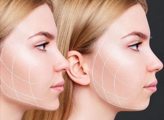 زاویه سازی صورت با ژل یا چربی