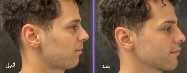 عکس قبل و بعد زاویه سازی صورت 2